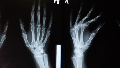 Mari "Menabung Tulang" Sejak Dini untuk Cegah Osteoporosis  di Masa Tua