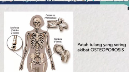 Waspada! Badan Bungkuk pada Kakek-Nenek Tanda Gejala Patah Tulang