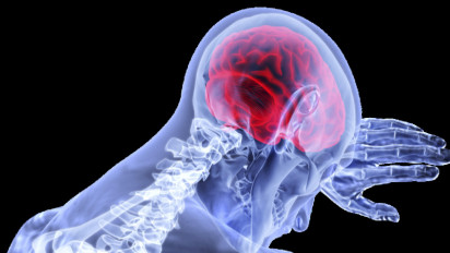 Jika Penanganan Stroke Dibawah 4,5 Jam, Kesembuhan Bisa Maksimal Bahkan Sempurna