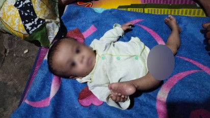 Lahir Tanpa Cangkang Lutut, Bayi di Aceh Tenggara Butuh Bantuan