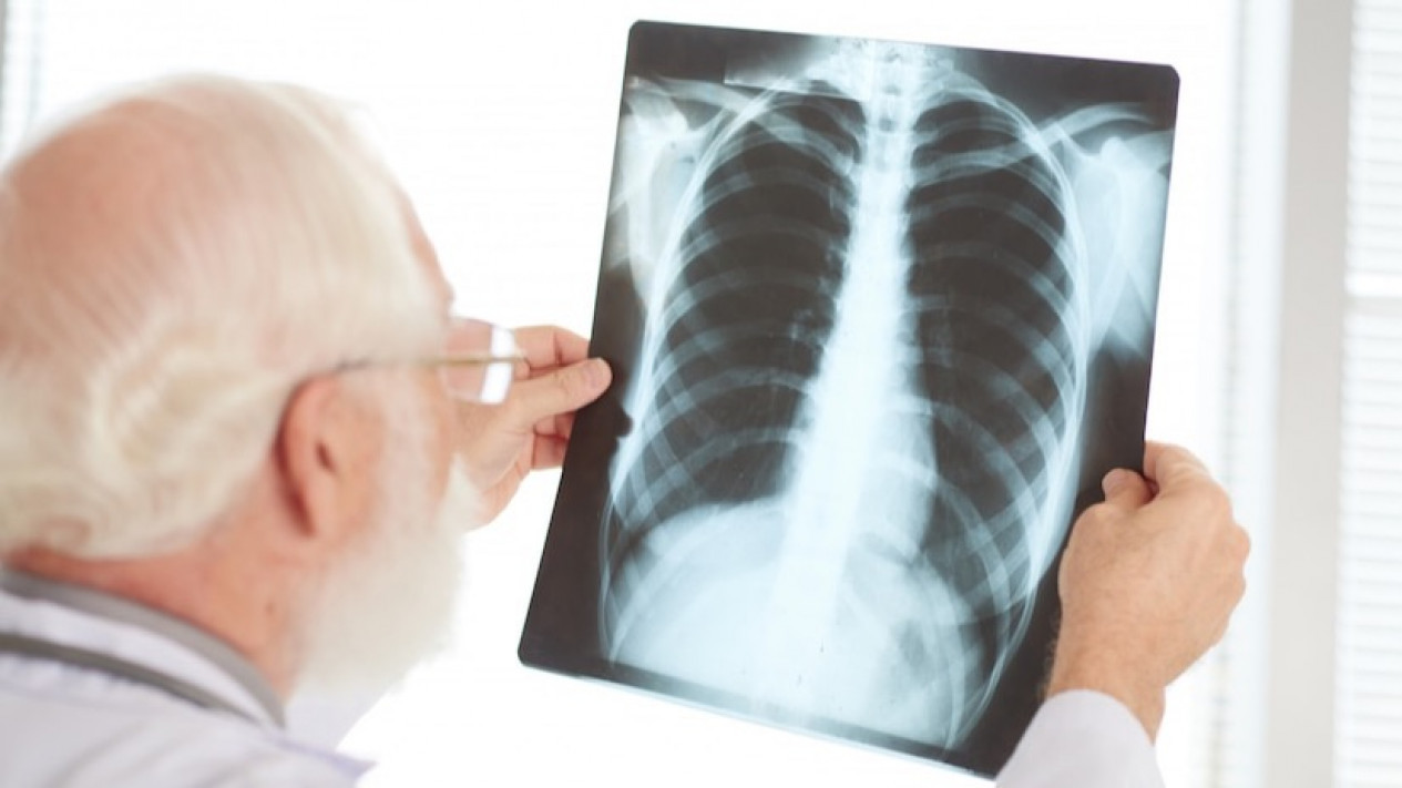 Kanker Paru Bisa Disembuhkan, Asal ...
            - galeri foto