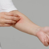 Dermatitis Atopik Masih Jadi Kasus Terbanyak pada Anak, Ini Penjelasan Ahli