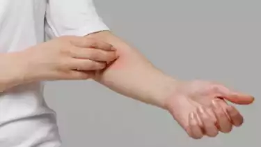 ilustrasi gatal alergi