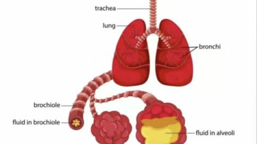 Apa Itu Pneumonia, Gejala, Penyebab dan Cara Pengobatannya