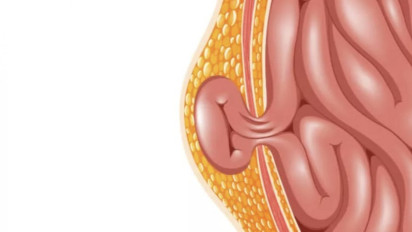Apa Itu Hernia, Gejala, Penyebab dan Cara Pengobatannya