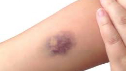 Kerap Menemukan Memar di Tubuh Tanpa Sebab? Hati-Hati Menunjukkan Tanda-Tanda Diabetes