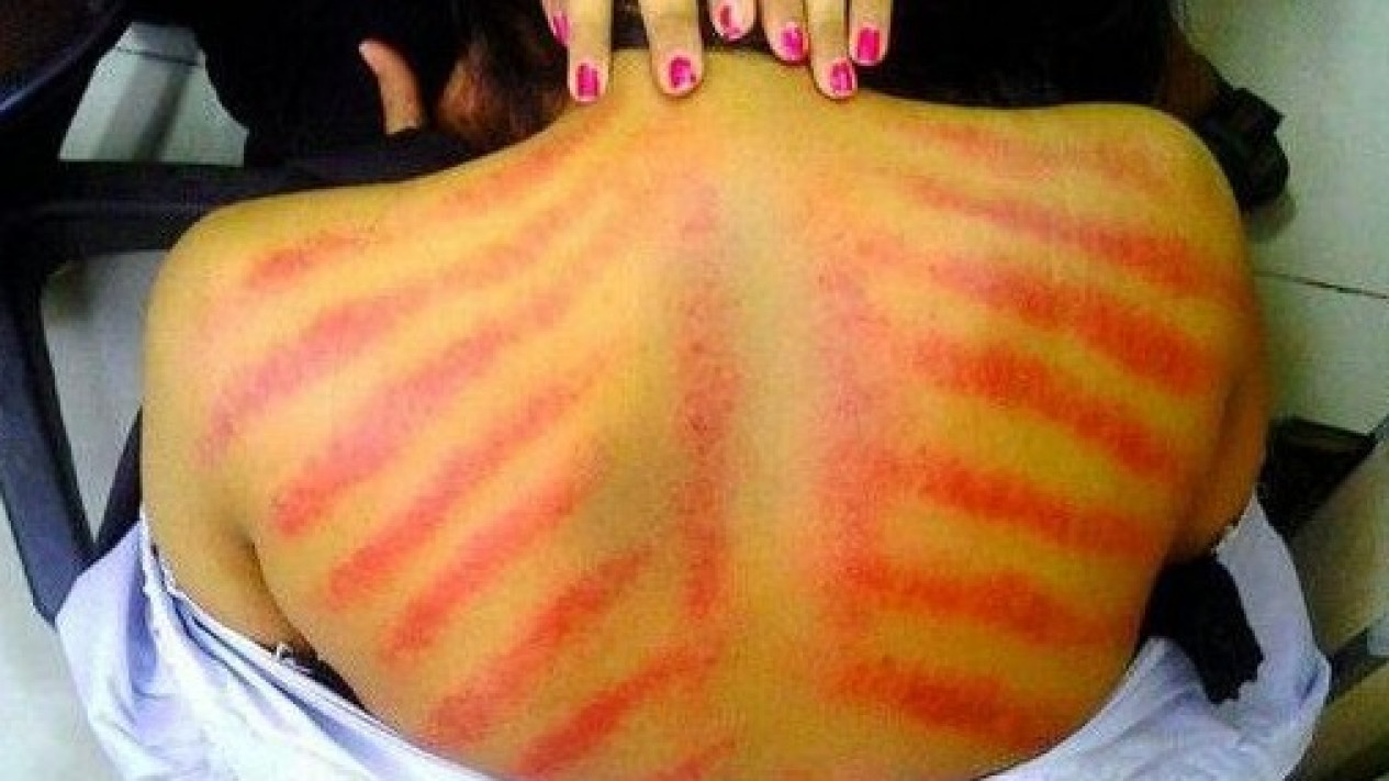 Kerokan untuk Ibu Hamil Apakah Diperbolehkan?
            - galeri foto