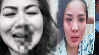 5 Artis Cantik Ini Alami KDRT Seperti Venna Melinda, Babak Belur 'di-Smackdown' Suami Sampai Cedera Parah