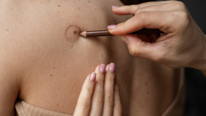 Gejala Awal Kanker Kulit yang Jarang Disadari, Ternyata Hal 'Wajar' ini Juga Jadi Salah Satunya