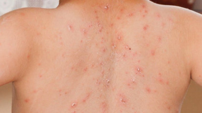 WNA Australia Terkena Campak Usai Perjalanan dari Bandung, Kemenkes Respons Begini