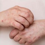 Alarm Peningkatan Kasus Campak di Indonesia, Anggota DPD Minta Pemda Pastikan Vaksinasi Merata