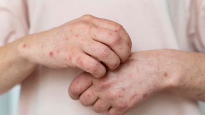 Jangan Anggap Sepele, Dokter Ingatkan Bahaya Komplikasi Campak