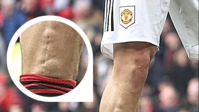 Foto Bekas Jahitan Patah Kaki Luke Shaw Viral, Nyaris Amputasi kena Tekel Brutal