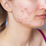 4 Bahan Alami yang Dipercaya Ampuh untuk Menghilangkan Bekas Jerawat Menghitam di Wajah