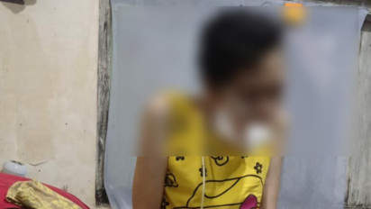 Perjuangan Seorang Ibu Tiga Anak asal Kota Malang Melawan Kanker Lidah, Ini Ceritanya