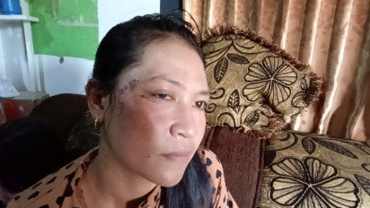 Pelaku Penyiraman Air Keras Terhadap IRT di Kerinci Jambi Belum Tertangkap, Korban Alami Gangguan pada Mata