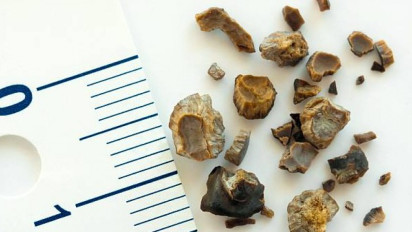 Ternyata Ada Resep Ramuan Obat Herbal Hancurkan Batu Ginjal ala dr Zaidul Akbar, Praktis, Murah dan Mudah