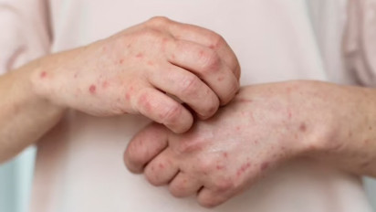 Si “Raja Singa” Menghantui Manusia, Kenali Penyakit Sifilis dari Gejala, Tahapan, dan Bahayanya