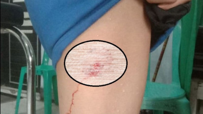 Satu Warga Meninggal, Pemkab Timor Tengah Selatan Tetapkan KLB Rabies