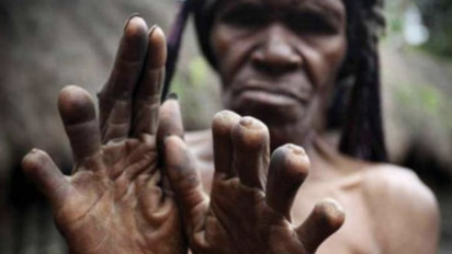 Mengenal Tradisi Ektrem Potong Jari dari Suku Dani Papua, Cara Berduka untuk Kerabat yang Meninggal