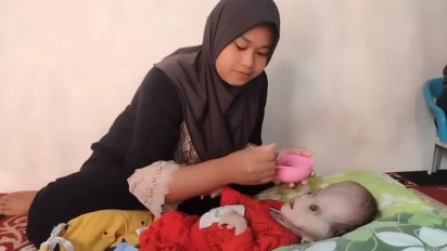 Bayi Pengidap Hidrosefalus di Kabupaten Tasikmalaya Butuh Bantuan Biaya Operasi