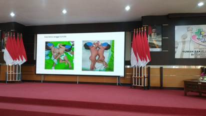 Operasi Bayi Kembar Siam Pertama Kali akan Dilakukan RSUD Syaiful Anwar di Malang