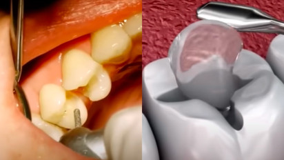 Solusinya Bukan Dicabut dan Bukan Ditambal, Gigi Berlubang Ternyata Cukup di...