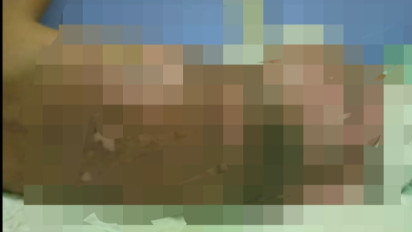 Nahas! Tercebur Kuah Sayur Panas, Balita di Ponorogo 50 Persen Kulitnya Melepuh, Begini Kronologisnya