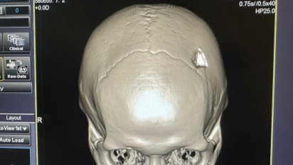 Tempurung Kepala Pecah dan Pembekuan Darah di Bagian Paru-paru, Pengunjung Hotel Diduga Dikeroyok