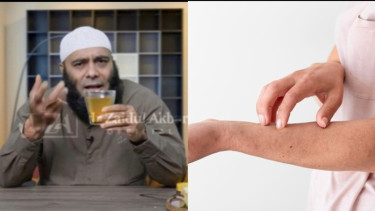 Mengalami Alergi? Begini Cara Mengatasinya Kata dr Zaidul Akbar, Alami Tanpa Obat