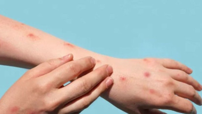 Waspada! Tujuh Kasus Cacar Monyet Ditemukan di Jakarta Selatan