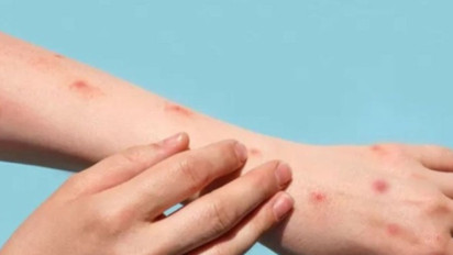 Pasien Cacar Monyet di Jakarta Semuanya Laki-laki, Tertular Lewat Hubungan Seksual