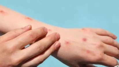 Kasus Cacar Monyet di DKI Meningkat, DPRD Dukung Bentuk Satgas Khusus Penanganan