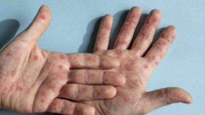 Kemenkes Ungkap Mpox di Indonesia 38 Kasus, Terbaru di Cirebon