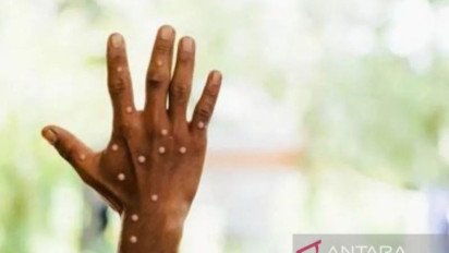 Sudinkes Jakarta Barat Umumkan Penambahan Kasus Cacar Monyet: Pasien Disolasi, Ada Riwayat Perjalanan ke Luar Negeri