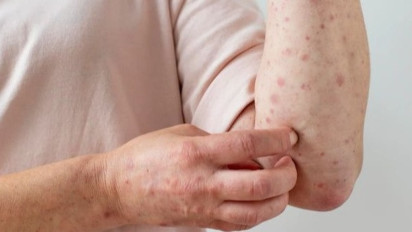 Kemenkes RI Ungkap Akan Ada Hibah dari ASEAN 2000 Dosis Vaksin Monkeypox