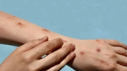 11 Pasien Cacar Monyet di Jakarta Barat Dinyatakan Sembuh, Semuanya Laki-laki