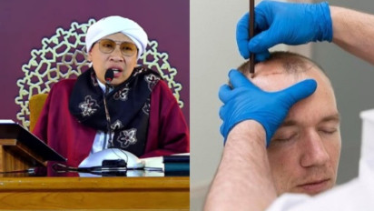 Hukum Transplantasi Rambut dalam Islam, Memangnya Boleh? Ini Penjelasan Buya Yahya
