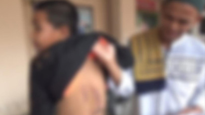 Diduga Disetrika Oleh Oknum Guru,  Seorang Santri di Parepare Alami Luka Bakar
