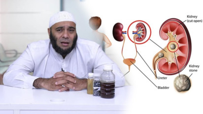 Cukup Pakai Obat Alami Ini Kata dr Zaidul Akbar InsyaAllah Batu Ginjal Hancur
