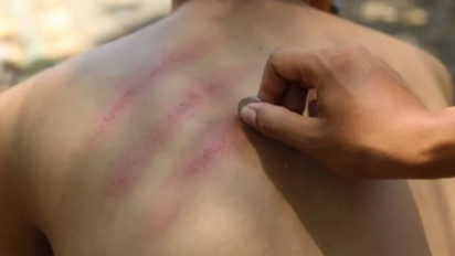 Kerokan Bukan Budaya Asli Indonesia, Ternyata Telah Dikenal dari Abad ke-5 di Negara Ini