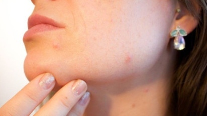 Muncul Jerawat saat Puasa? Ternyata Kata Dokter Makanan saat Berbuka yang Jadi Penyebabnya