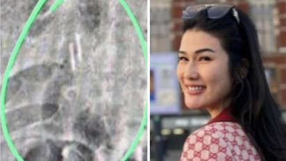 Dokter Bocorkan Soal Benda Asing Mirip Paku di Tubuh Stevie Agnecya, Benarkah Kena Santet?