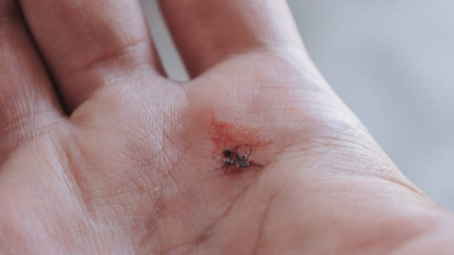 Duh, Wilayah Ini Terbanyak Alami Kasus Kematian Akibat DBD, Kemenkes: Sudah 316 Meninggal