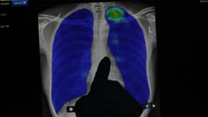 Mitos Tentang Paru-Paru Basah, Ini Faktanya?