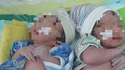 Bayi Kembar Siam Miliki Satu Alat Kelamin Dirujuk ke RSUD dr Iskak Tulungagung