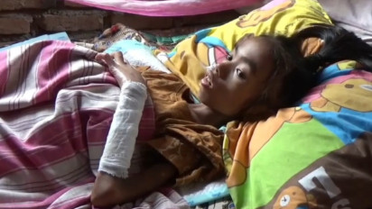 Suara Rintihan Bocah SD di Pariaman, Kulit Terbakar hingga Alami Lumpuh dan Gizi Buruk