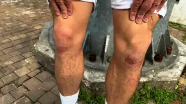 Foto Dengkul Thom Haye yang Lecet setelah Selebrasi Knee Slide untuk Gol Pertamanya bagi Timnas Indonesia, Coach Justin Salahkan Rumput GBK