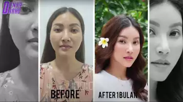 Wajah Sarwwendah sebelum dan sesudah menjalani operasi plastik