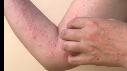 Mengerikan! 88 Kasus Cacar Monyet Ada di Indonesia, Diduga dari Hubungan Sesama Jenis, Ingatkan Pesan Ustaz Adi Hidayat Bisa Tak Melahirkan Generasi yang...